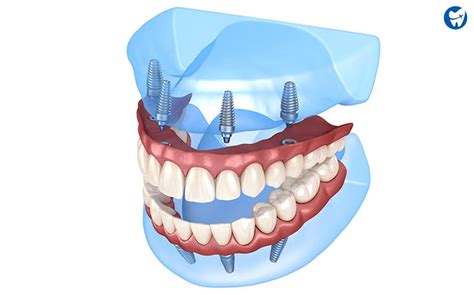 Dental Implants in Cambodia • Check Prices & Reviews .